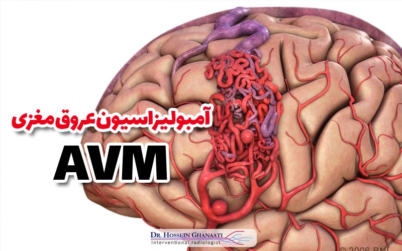 آمبولیزاسیون فیبروم رحمی 8 آمبولیزاسیون عروق مغزی Avm