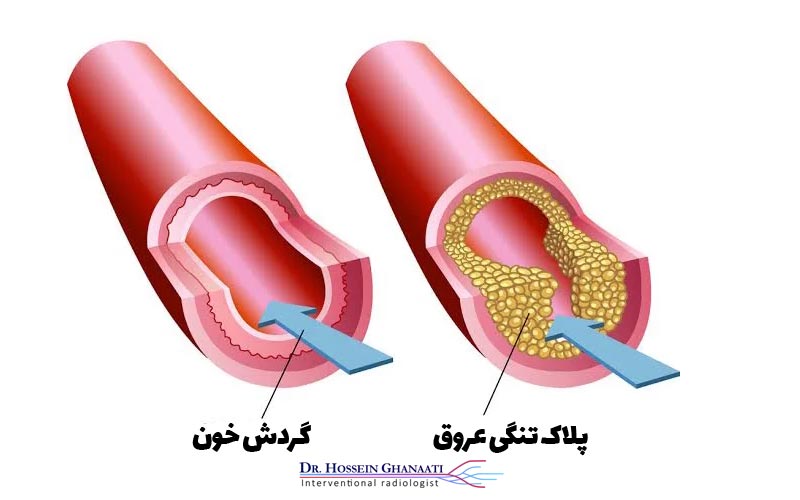 تنگی عروق چیست و چرا اتفاق می‌افتد