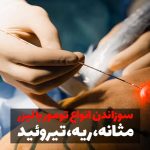 سوزاندن تومور با لیزر