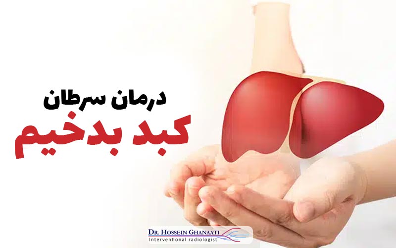 درمان سرطان کبد بدخیم