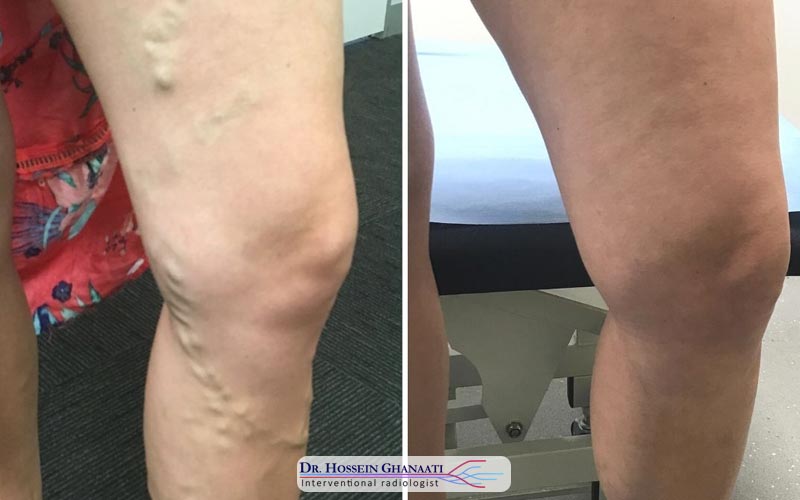 مقایسه درمان واریس پا با لیزر با روش‌های سنتی