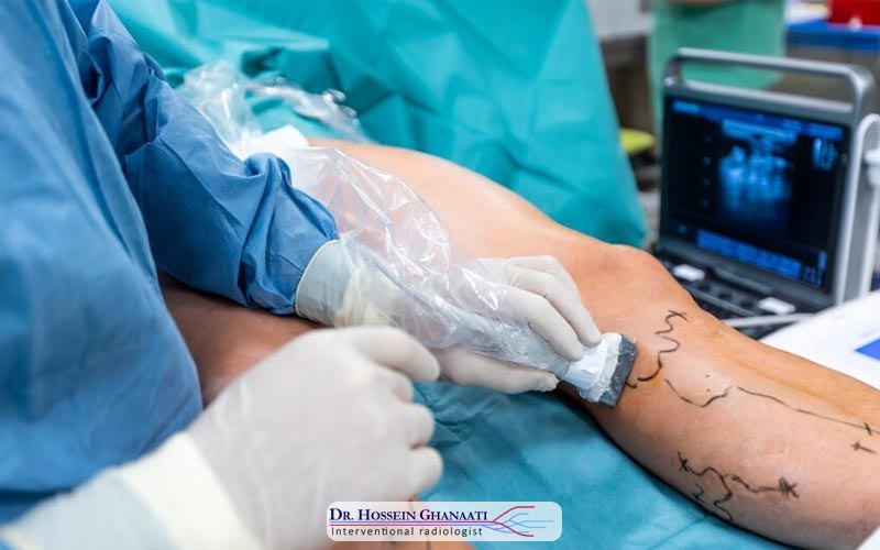 واریس پا چیست و چرا به وجود می‌آید؟