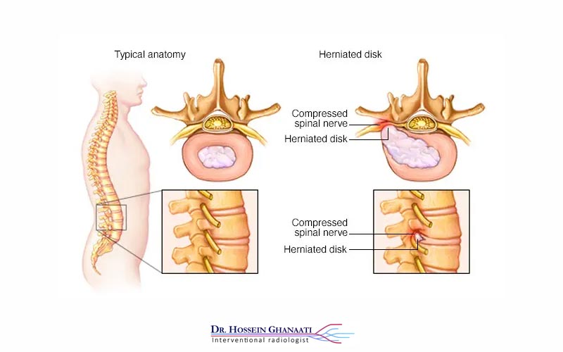 اینترونشن دیسک کمر چیست