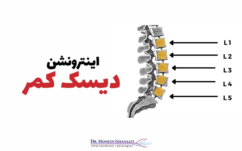اینترونشن دیسک کمر