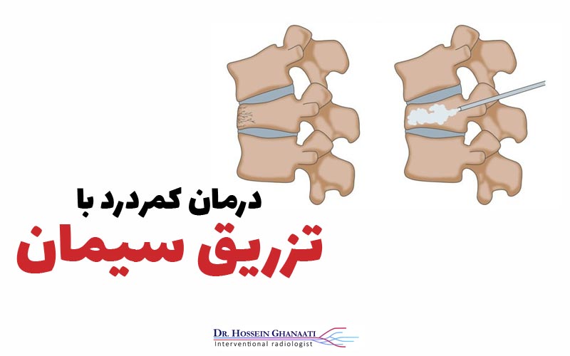 تزریق سیمان در مهره کمر