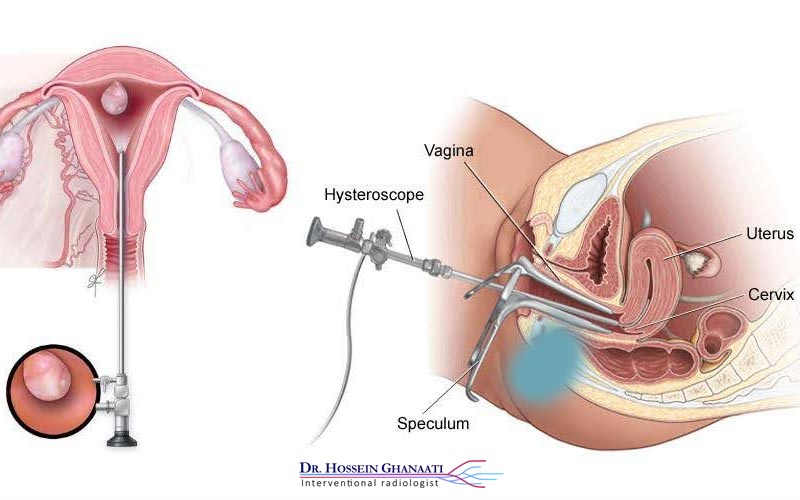 درمان فیبروم رحمی با لیزر