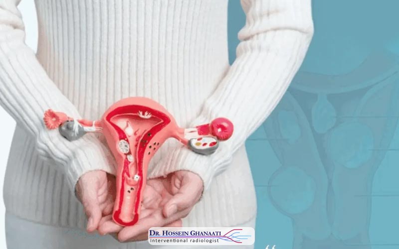 درمان فیبروم رحمی