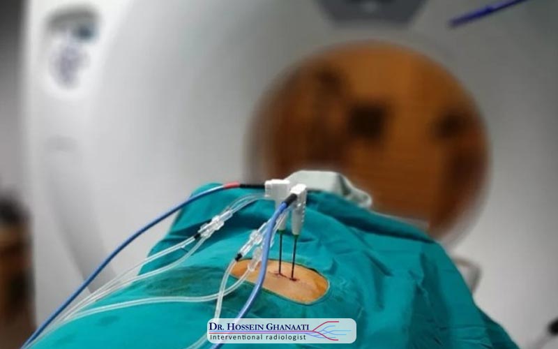 مایکروویو ابلیشن چیست 4 روش مایکروویو ابلیشن