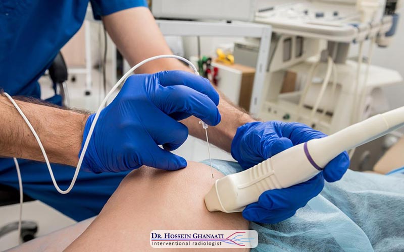 مایکروویو ابلیشن چیست 3 مایکروویو ابلیشن Microwave Ablation