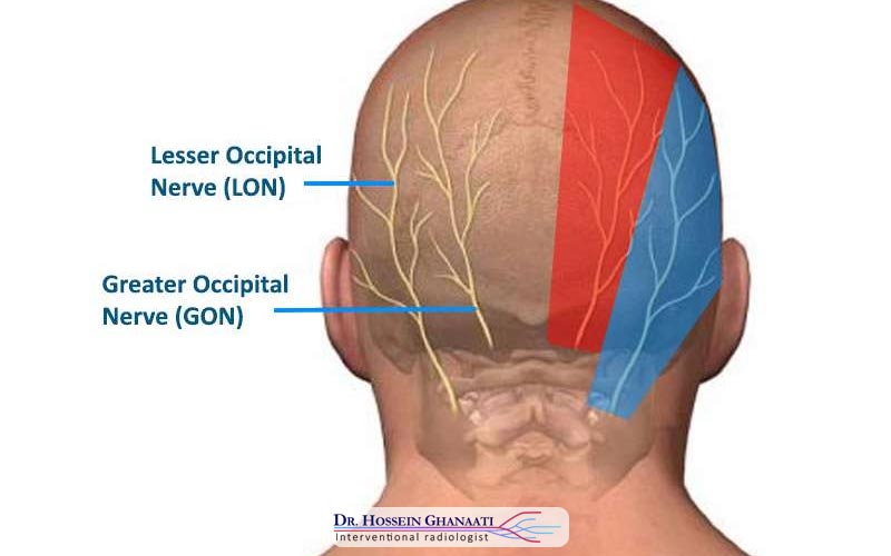 نورالژی اکسیپیتال
