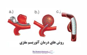 آنوریسم مغزی