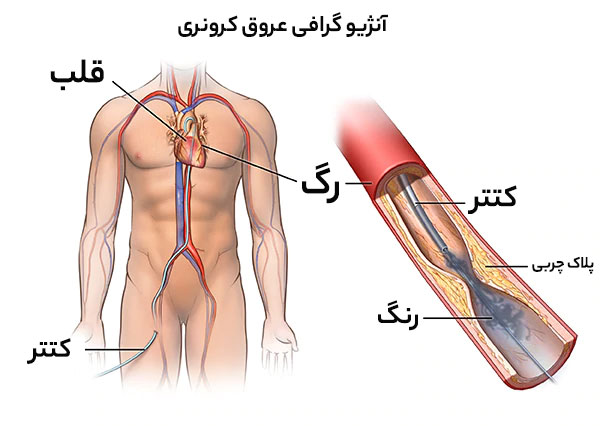 هدف از انجام ازمون آنژیوگرافی