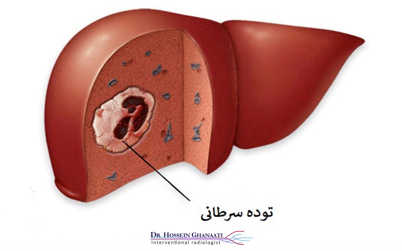 کموآمبولیزاسیون