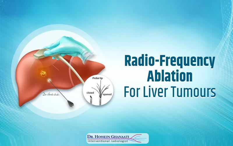 RF تومورهای کبدی یا رادیوفرکانسی کبدی