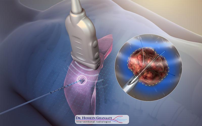 Rf تومورهای کبدی