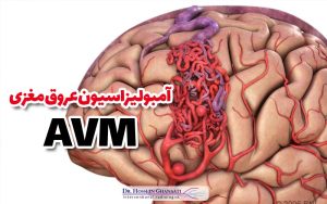 آمبولیزاسیون عروق مغزی Avm