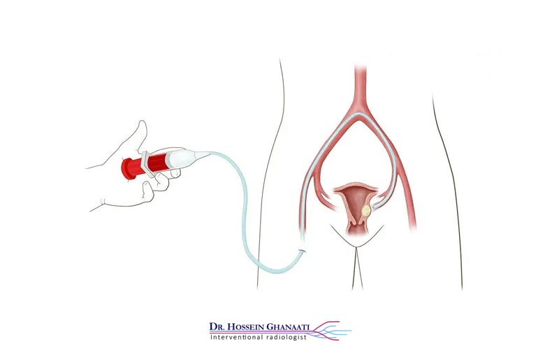آمبولیزاسیون فیبروم رحمی