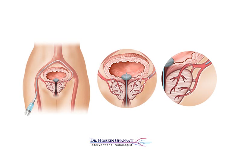 آمبولیزاسیون پروستات