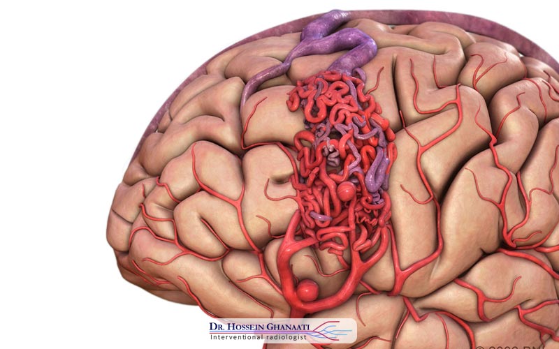 درمان AVM مغز