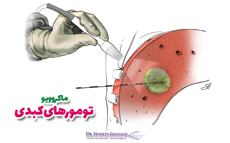 ماکروویو تومورهای کبدی 7 ماکروویو تومورهای کبدی