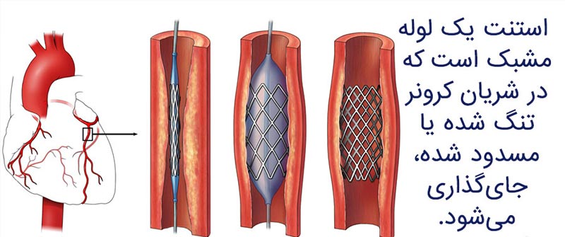 نحوه استنت گذاری عروق