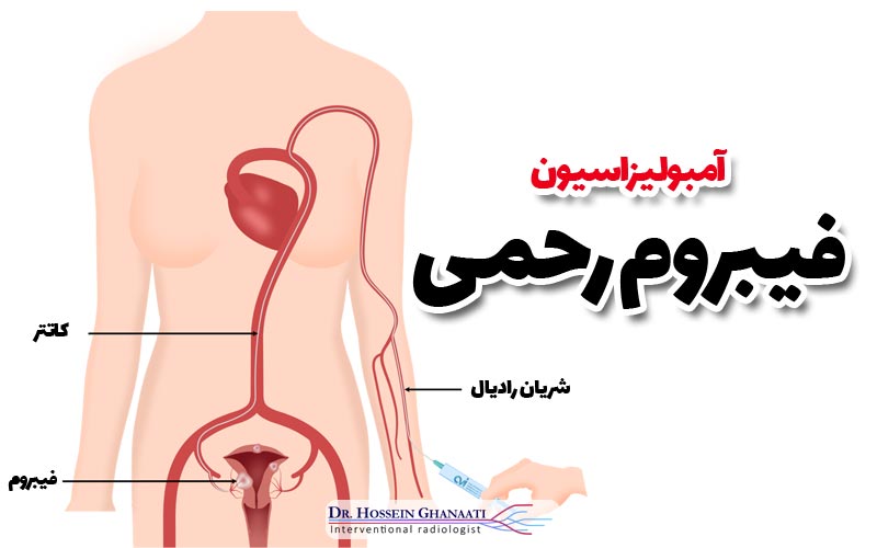 آمبولیزاسیون فیبروم رحمی 7 نحوه انجام آمبولیزاسیون فیبروم رحمی