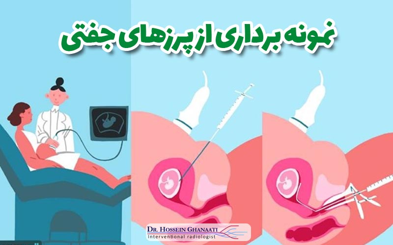نمونه برداری از پرزهای جفتی 7 نمونه برداری از پرزهای جفتی