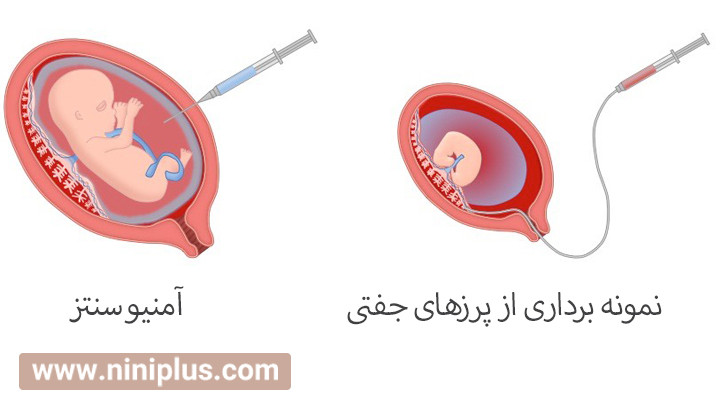 نمونه برداری از پرزهای جفتی و آمینوسنتز