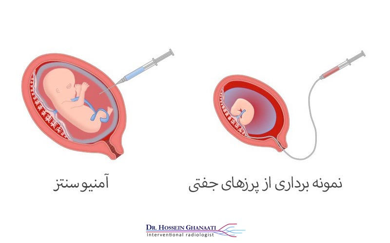 نمونه برداری از پرزهای جفتی