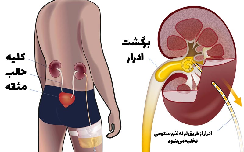 نفروستومی چیست 6 دلایل انجام نفروستومی چیست؟