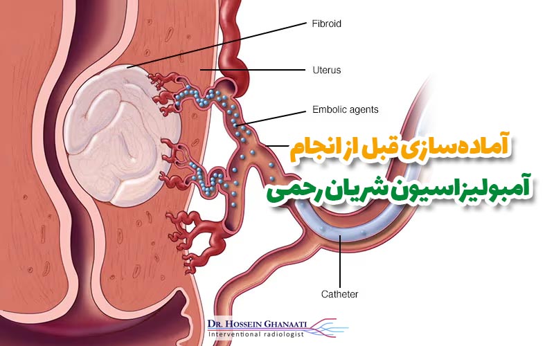 آماده‌سازی قبل از انجام آمبولیزاسیون شریان رحمی