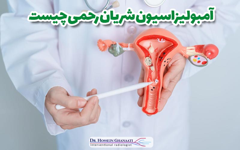 آمبولیزاسیون شریان رحمی 6 آمبولیزاسیون شریان رحمی چیست
