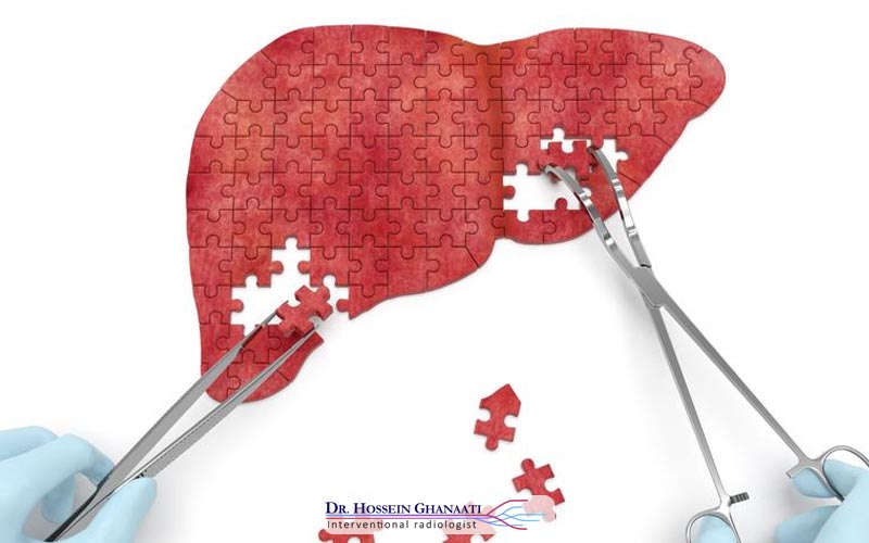 کموامبولیزاسیون 7 عوارض جانبی و خطرات احتمالی کموامبولیزاسیون