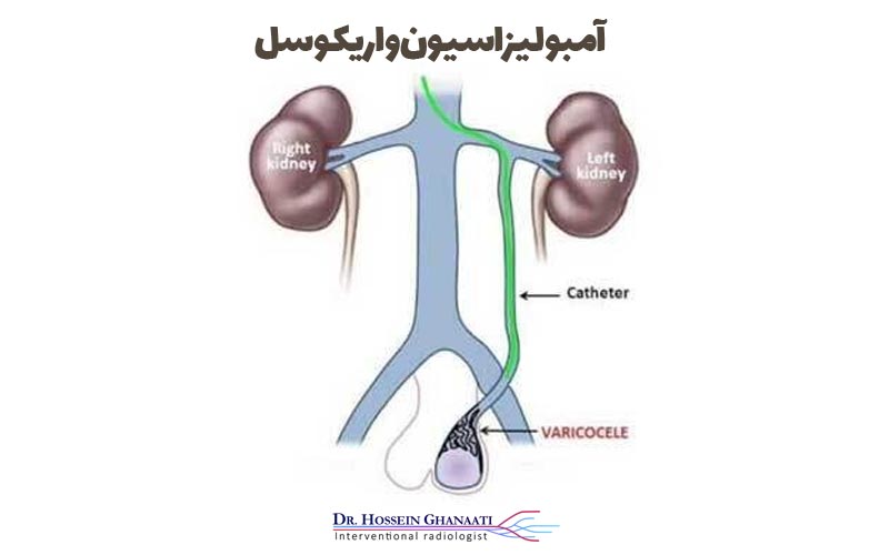 مزایای آمبولیزاسیون واریکوسل نسبت به جراحی