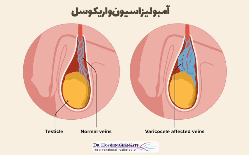 واریکوسل چیست و چگونه ایجاد می‌شود؟