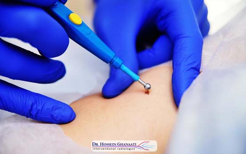 سوزاندن تومور با لیزر 1 مقدمهای بر سوزاندن تومور با لیزر