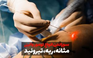 سوزاندن تومور با لیزر