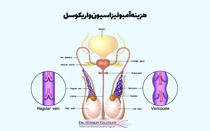 هزینه آمبولیزاسیون واریکوسل