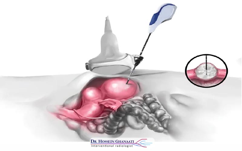 درمان فیبروم رحمی با لیزر