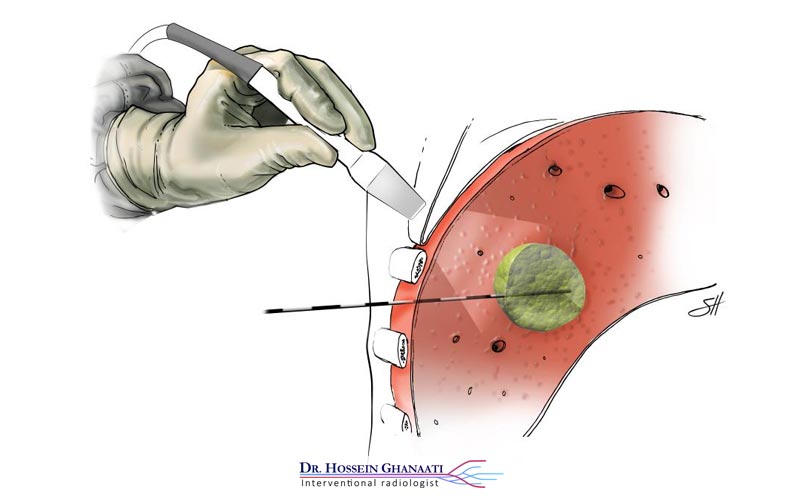 مایکروویو ابلیشن چیست
